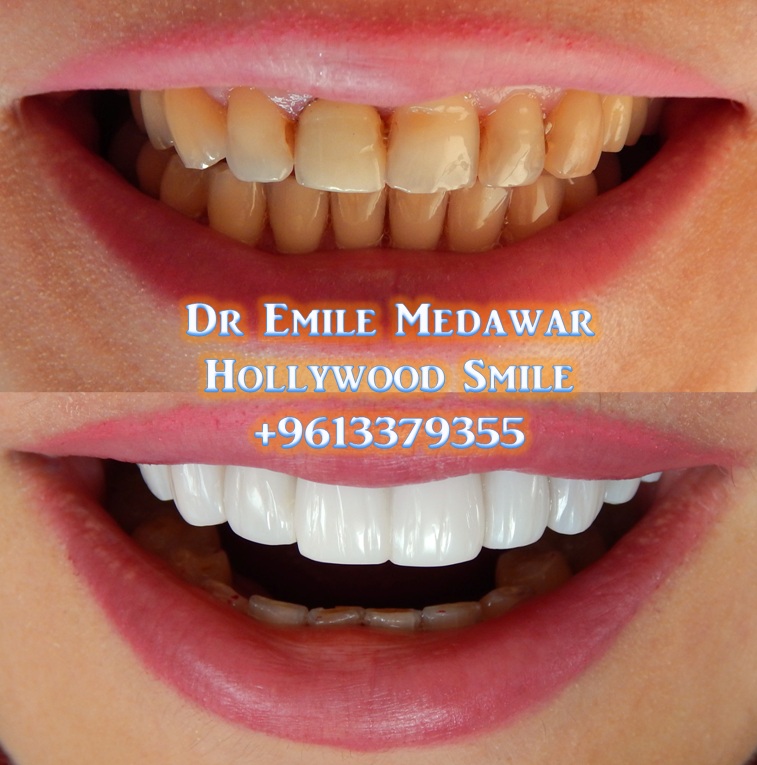 Direct Vs Indirect Veneers direct and indirect Veneer / The different