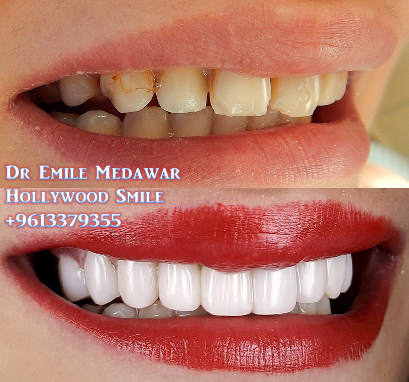 Direct Veneers