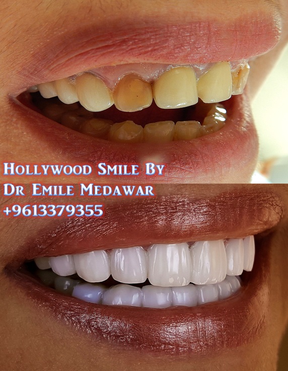Emax Veneers