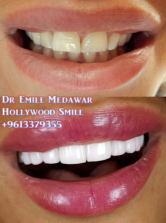 Emax Veneers