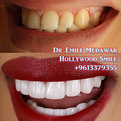 veneers beirut