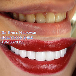 veneers lebanon beirut