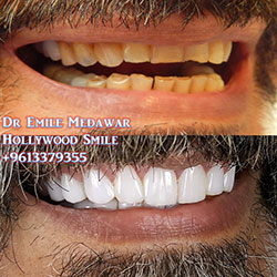 veneers beirut lebanon
