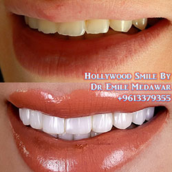 veneers lebanon