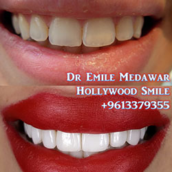 best veneers lebanon