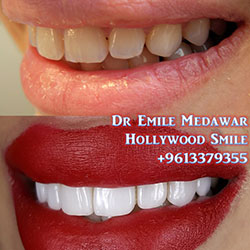 veneers cost lebanon