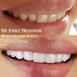 veneers price lebanon