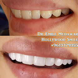 veneers cost beirut