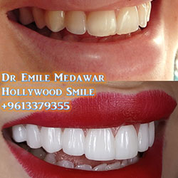 veneers price beirut