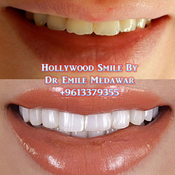 veneers in beirut lebanon