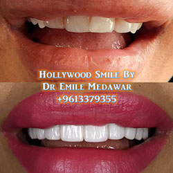 best veneers in lebanon