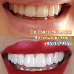 top veneers lebanon