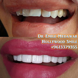 top veneers dentist