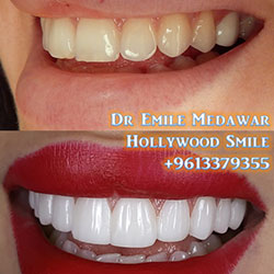 celebrity veneers lebanon