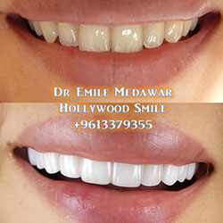 veneers lebanon