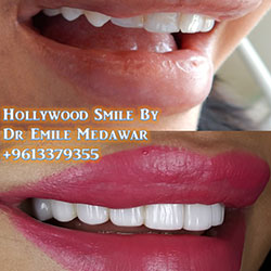 veneers beirut