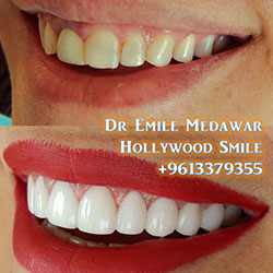 best veneers beirut
