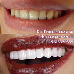veneers in lebanon beirut