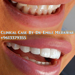 veneers lebanon
