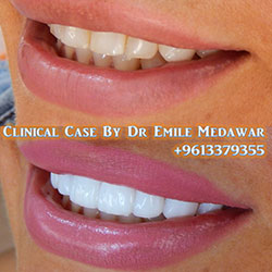 veneers lebanon