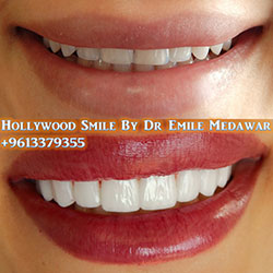 veneers lebanon