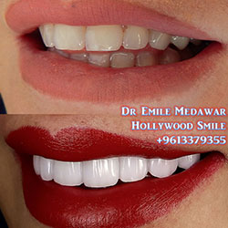 porcelain veneers in lebanon