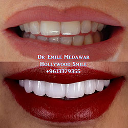 porcelain veneers beirut