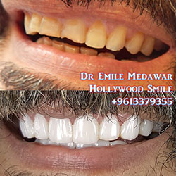 best veneers in lebanon