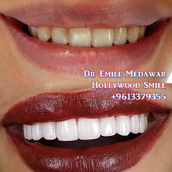 top veneers in lebanon