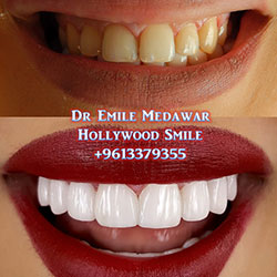 veneers lebanon