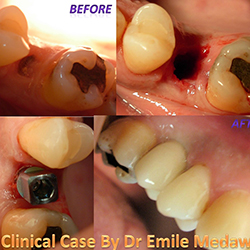 dental implants lebanon