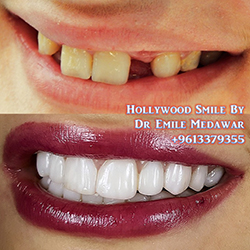 dental implants beirut