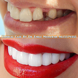 dental implantslebanon beirut