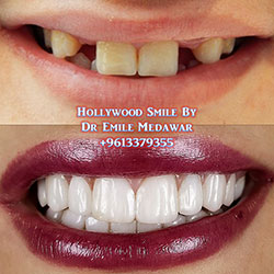 dental implantslebanon
