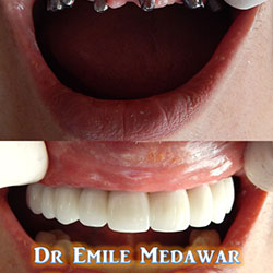dental implants beirut