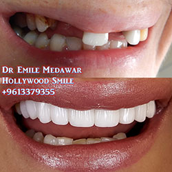 dental implants price lebanon