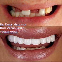 dental implants price beirut