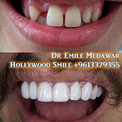 best dental implants lebanon