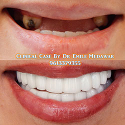 top dental implants lebanon