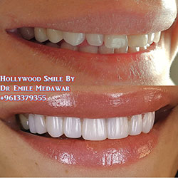 veneers lebanon