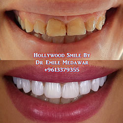 dental implants lebanon