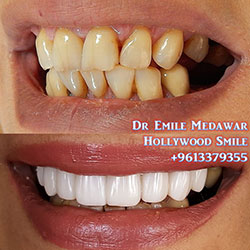dental implants beirut