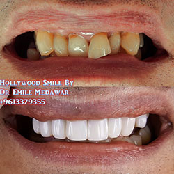 teeth whitening lebanon