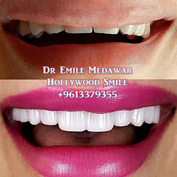veneers price lebanon