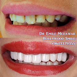 veneers lebanon