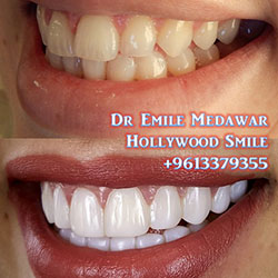 veneers beirut