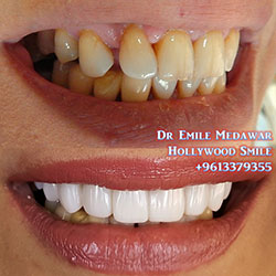 veneers