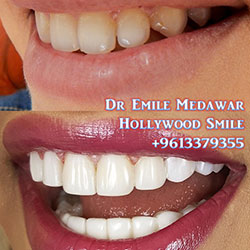 porcelain veneers lebanon