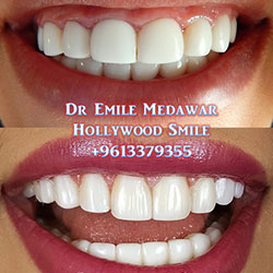 porcelain veneers
