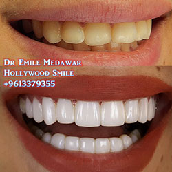 ceramic veneers